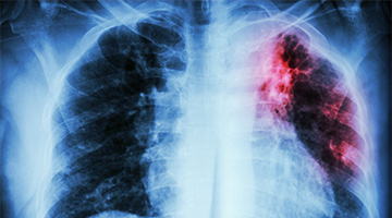 TB & NTM Differentiation - Mali